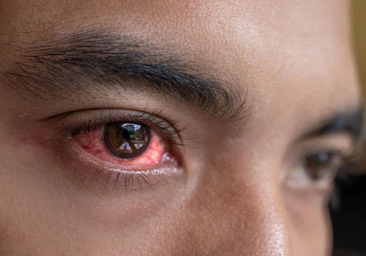 Outbreak of Red Eye Disease in Nairobi and Kisii Raises Concerns